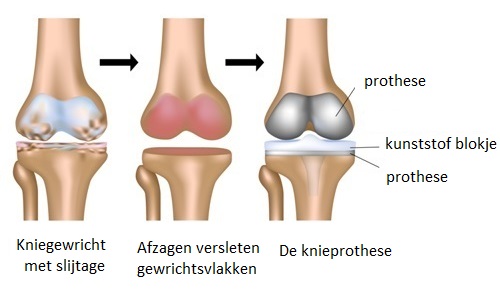 Op deze afbeelding ziet u wat er met het kniegewricht gebeurt tijdens de operatie
